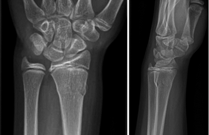 Fracturas infantiles